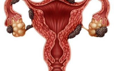 Endometriosis: Quiero ser madre